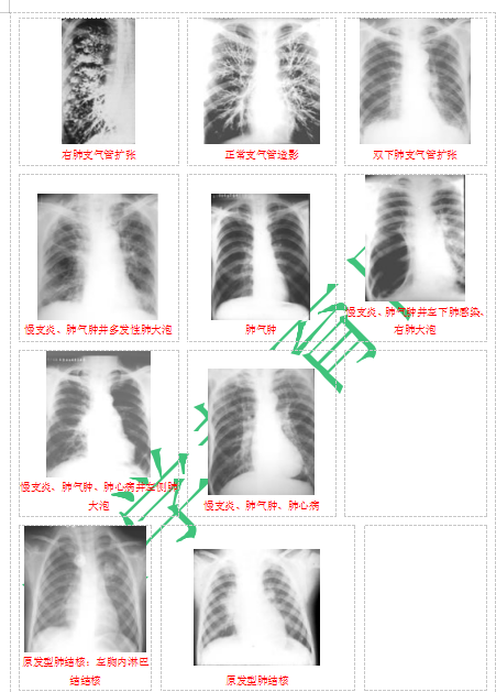 快收藏！臨床助理醫(yī)師實踐技能62個胸片（圖片診斷）