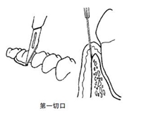 翻瓣術