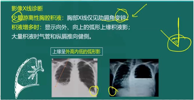 胸腔積液影像X線(xiàn)診斷